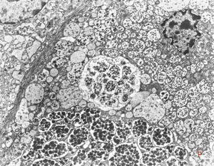 normal seromucinous salivary gland